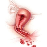 dysfunctional-uterine-bleeding